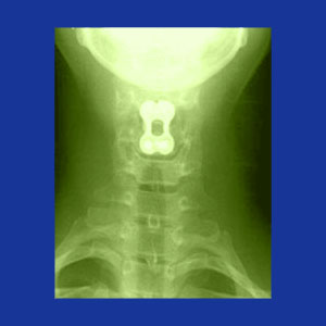 Anterior cervical fusion