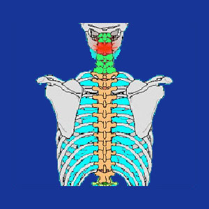 broken neck