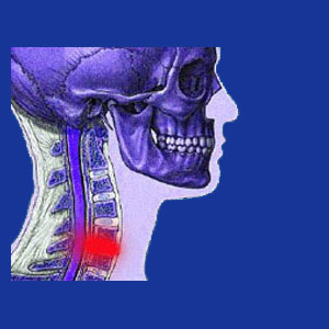 bulging disc in the neck