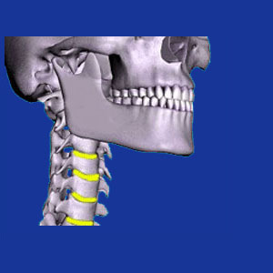 Cervical arthritis