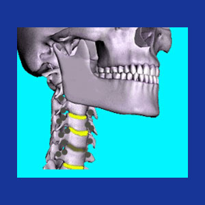 Cervical bone spurs