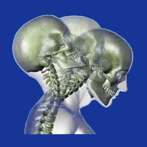 Cervical degenerative disc disease