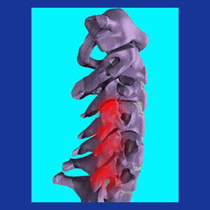 Cervical degenerative joint disease