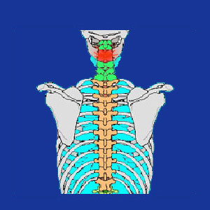 cervical disc extrusion