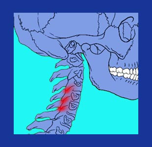 Cervical facet syndrome