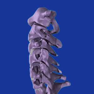 Cervical foraminal stenosis