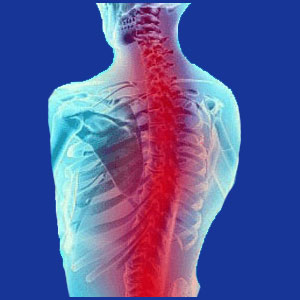 Cervical kyphosis