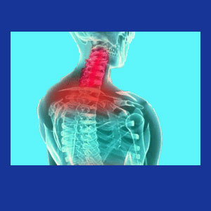 Cervical myelopathy