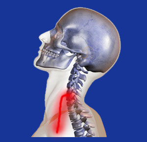 Cervical nerve compression