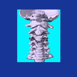 Cervical osteophytes