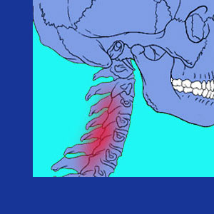 Cervical pain