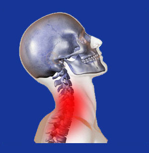 cervical prolapsed disc