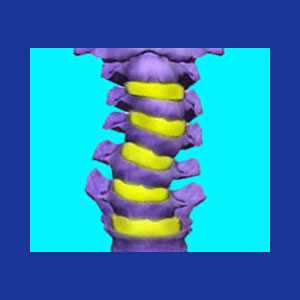 Cervical scoliosis