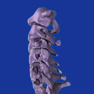 cervical spinal fracture