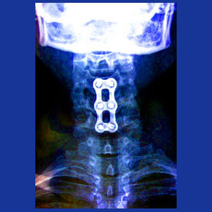 Cervical spinal fusion