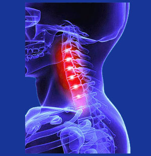 Chronic neck pain