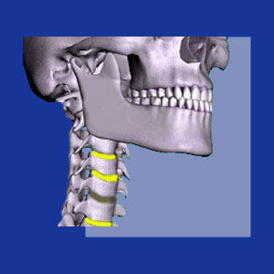 Degenerated Cervical Disc