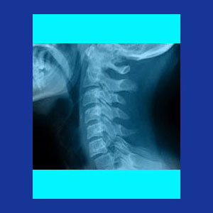 Degenerative disc disease neck pain