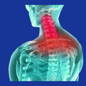 Loss of cervical lordosis