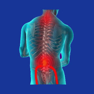 Neck pain and sciatica