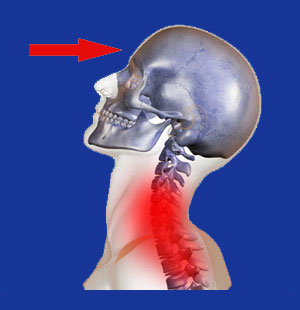 Neck Pain from Pressure on Forehead