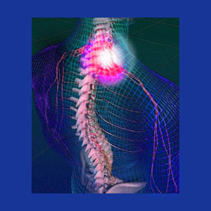 pinched cervical nerve