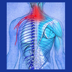 ruptured cervical disc