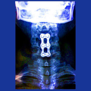 Spinal Fusion in the Neck