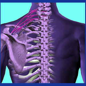 Thoracic outlet syndrome