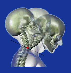 unstable cervical spine